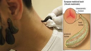 manfaat terapi lintah di lidah